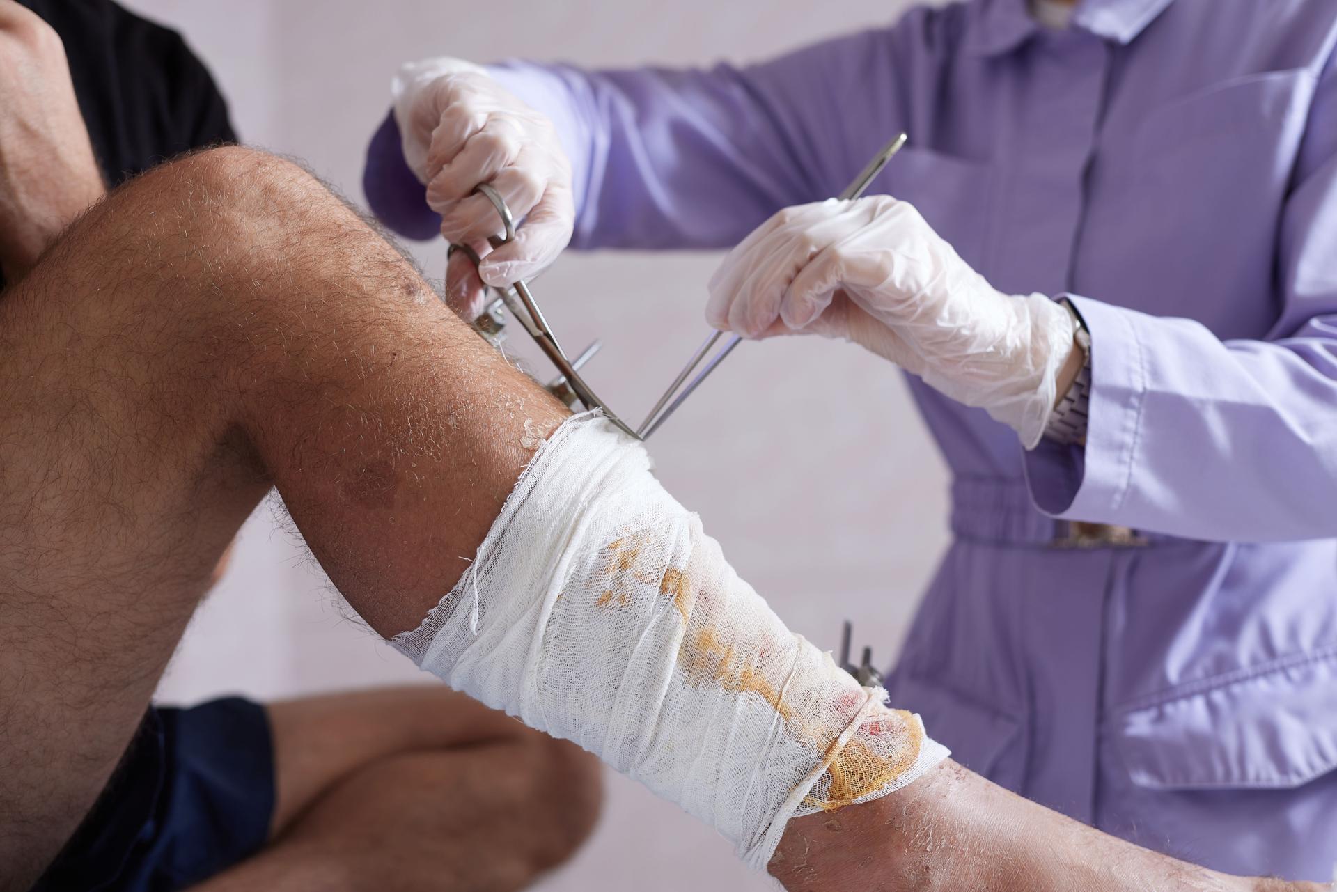 doctor bandaging a leg, leg injury, selective focus
