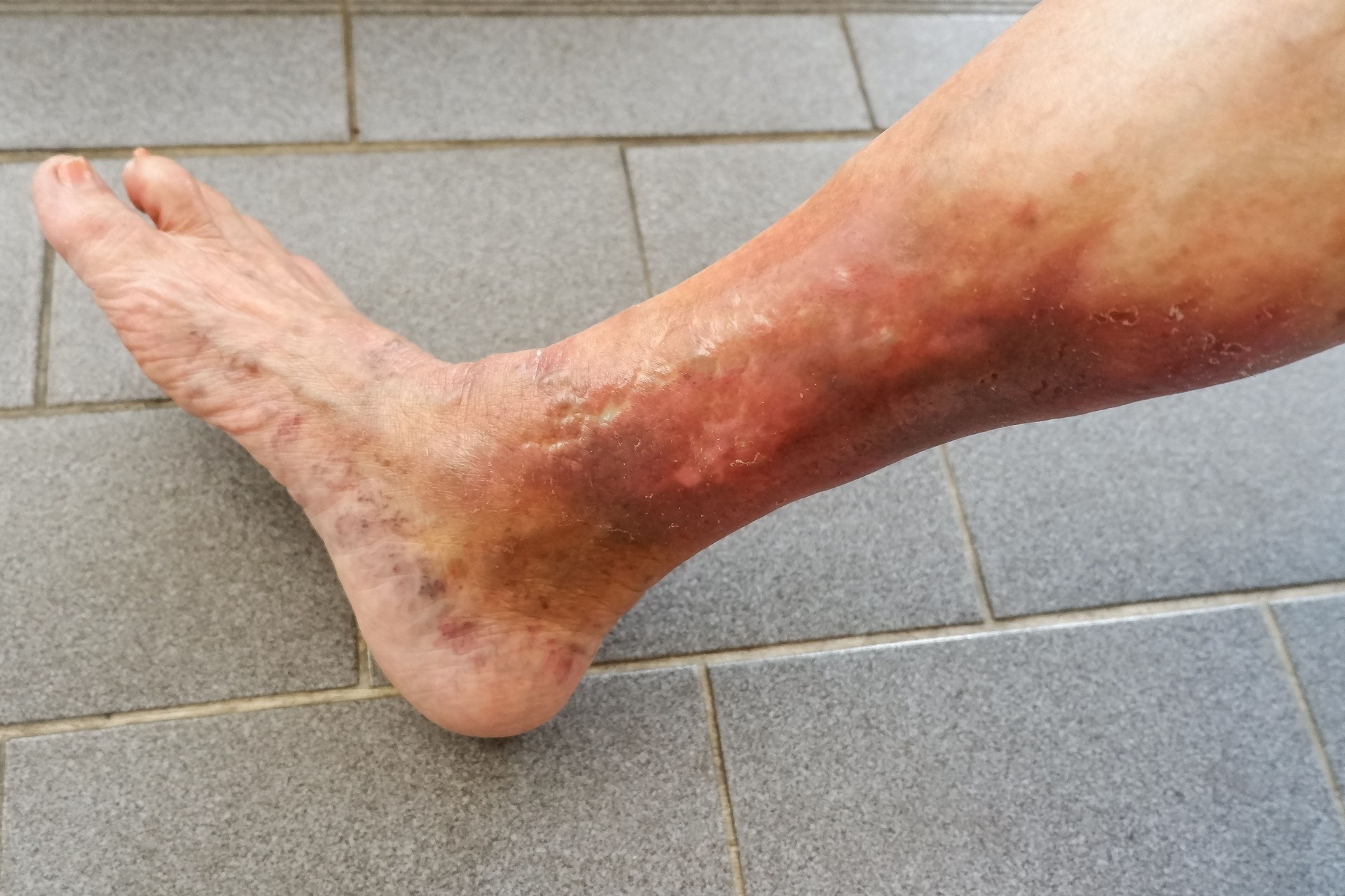 Varicose veins and it’s complication.